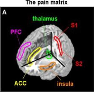 from Moisset and Bouhassira (2007) "Brain imaging of neuropathic pain"